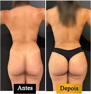 ANTES E DEPOIS 06